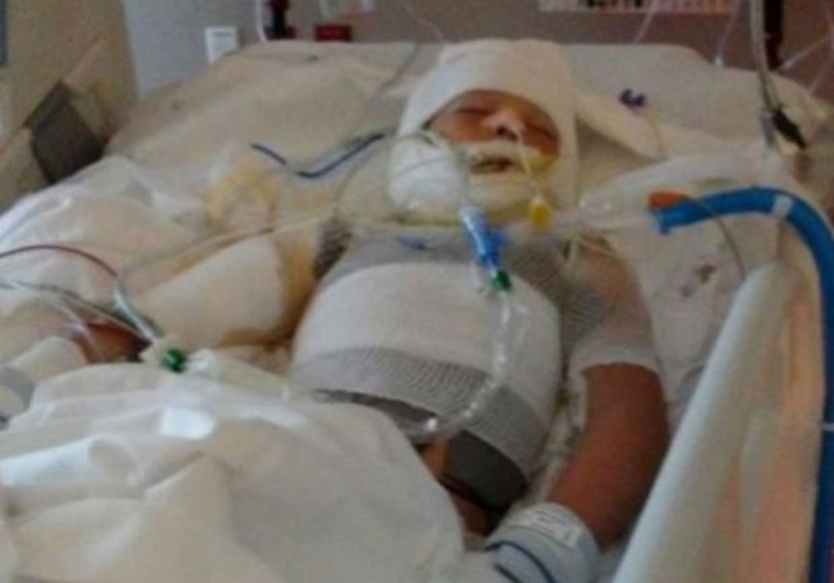 Χαροπαλεύει 10χρονος θύμα bullying – Tον περιέλουσε με βενζίνη και του έβαλε φωτιά [pics]