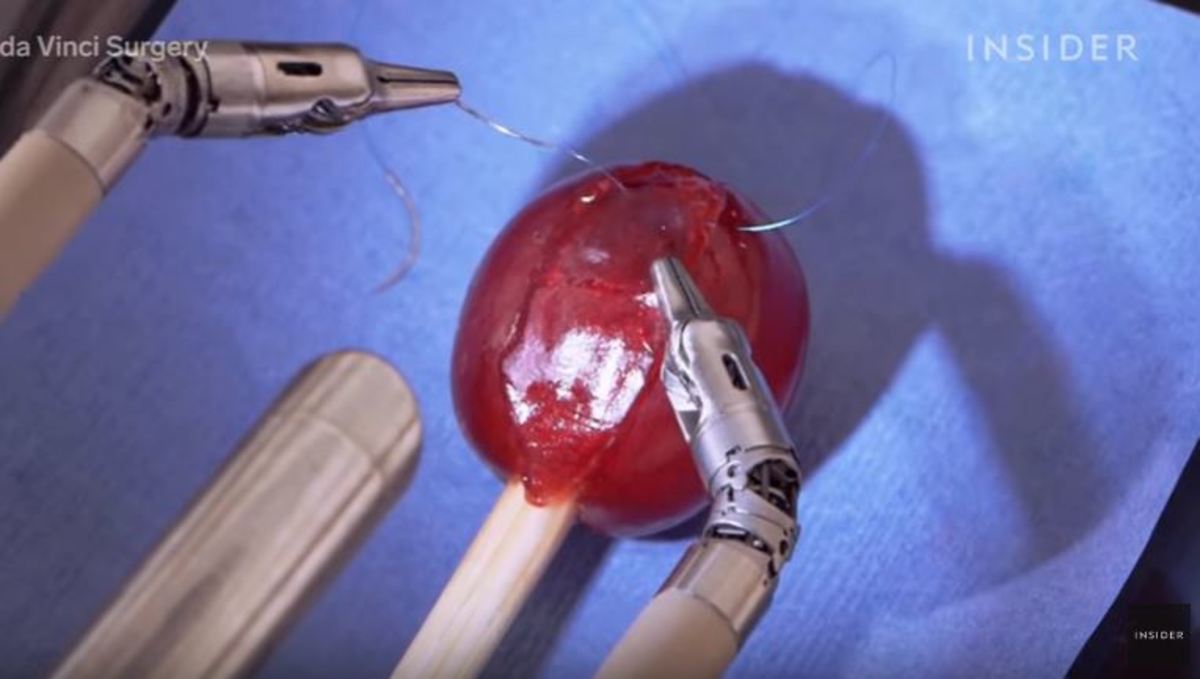 Εντυπωσιακό: Ρομπότ κάνει εγχείρηση σε σταφύλι