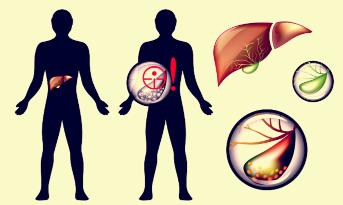 Πέτρες στην χολή: Συμπτώματα, αντιμετώπιση και πρόληψη
