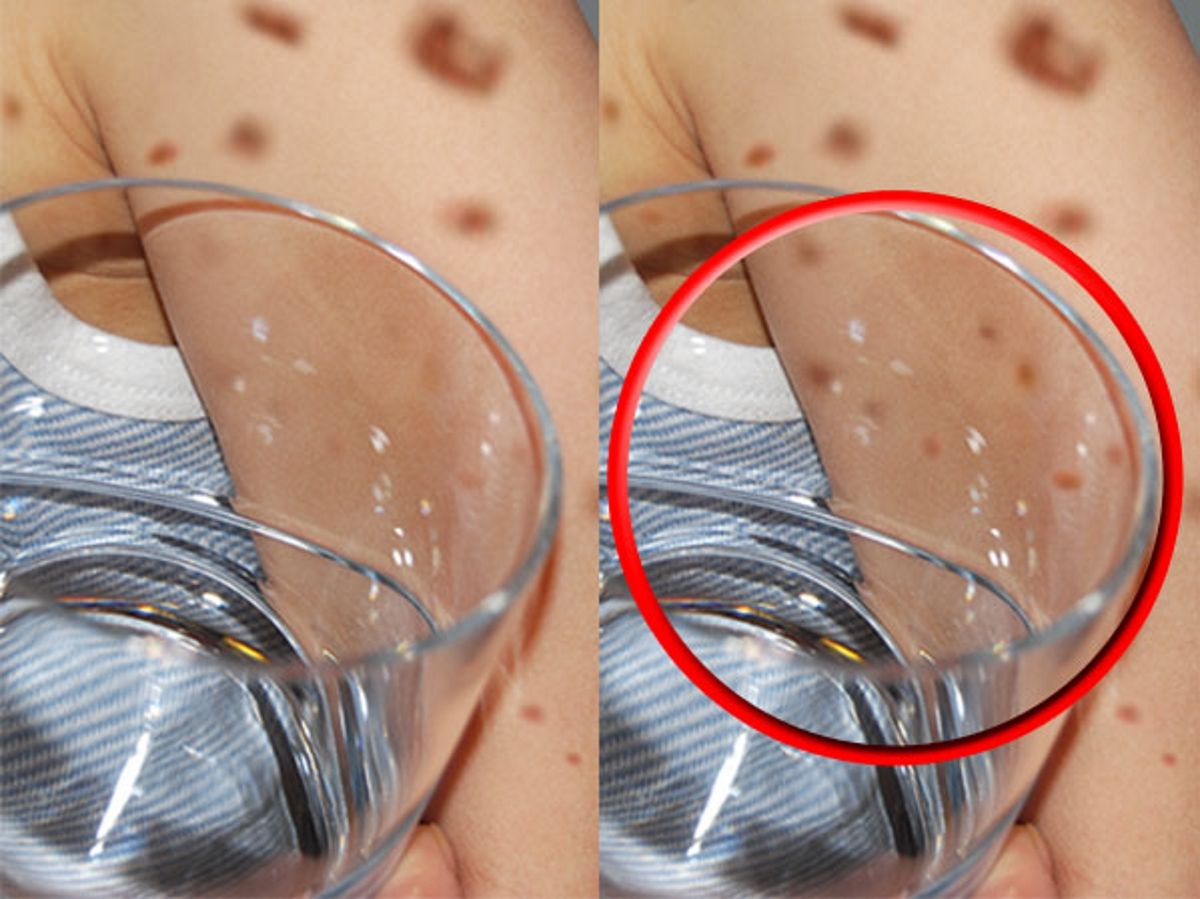 Μηνιγγίτιδα: Πώς γίνεται το “τεστ” με το ποτήρι που ακουμπάς στο δέρμα!