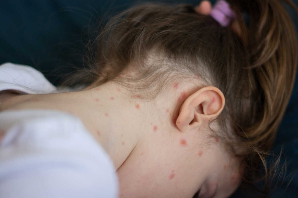 Επιδημία ιλαράς στη Ρουμανία – Ανεμβολίαστα παιδιά οι περισσότεροι ασθενείς