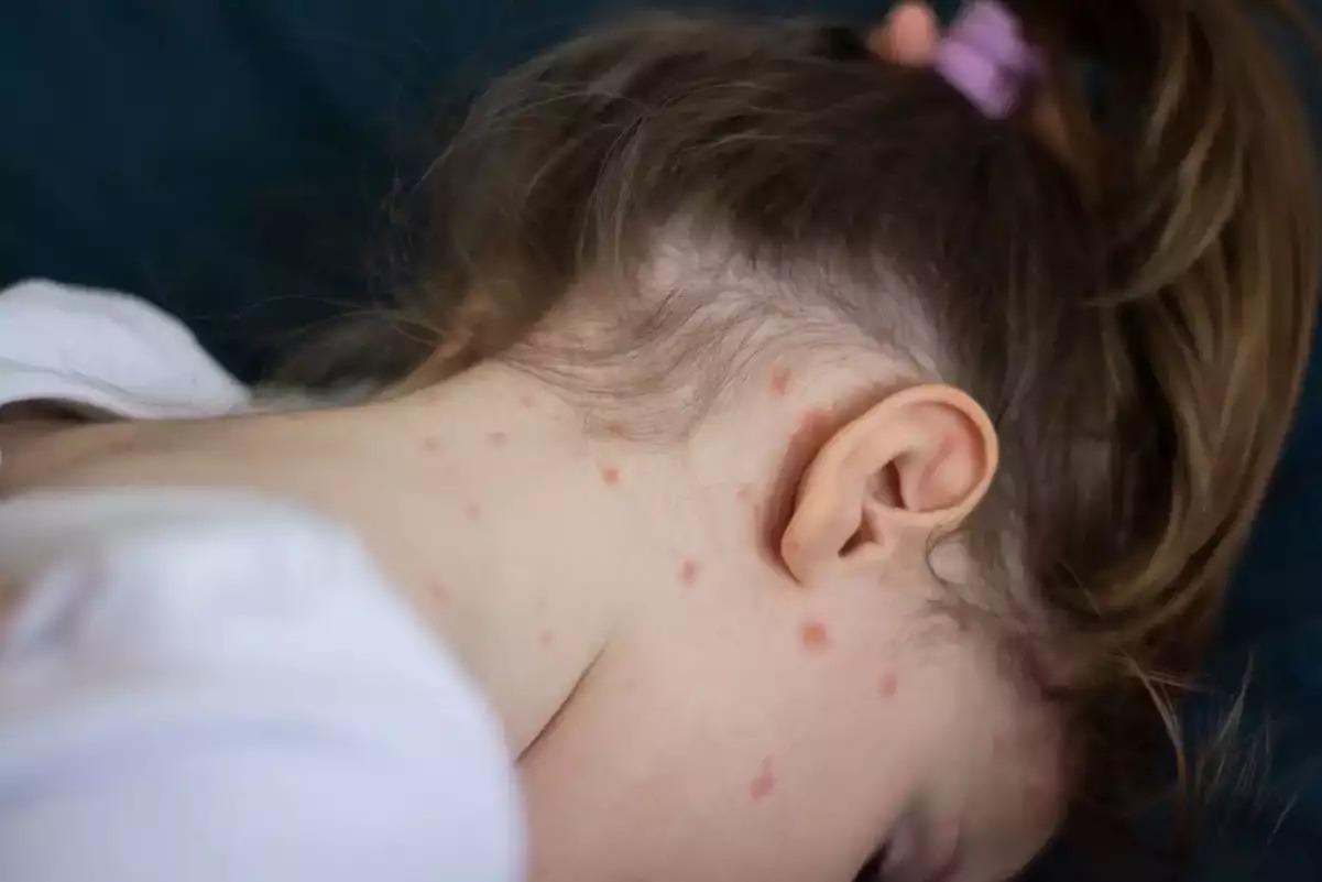 Καναδάς: Παιδί πέθανε από ιλαρά στο Οντάριο, ο πρώτος θάνατος σε αυτή την επαρχία από το 2013