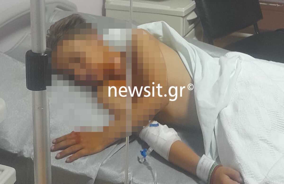 Πάτρα: «Ζήσαμε εμπόλεμες συνθήκες, ο γιος μου με ρώτησε αν θα πεθάνει», λέει στο newsit.gr ο πατέρας του 9χρονου που τραυματίστηκε από βεγγαλικά