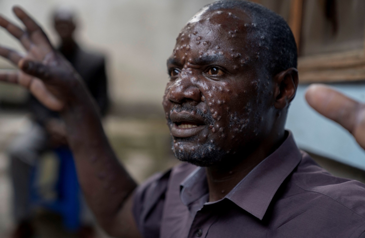 Jean Kakuru Biyambo, 48, a father of six from the Muja internally displaced persons camp, gestures outside his room at the Goma general hospital where he has been receiving treatment against Mpox - an infectious disease caused by the monkeypox virus that spark-off a painful rash, enlarged lymph nodes and fever; following Mpox cases in Nyiragongo territory, in Goma, North Kivu province, Democratic Republic of the Congo July 16, 2024. REUTERS