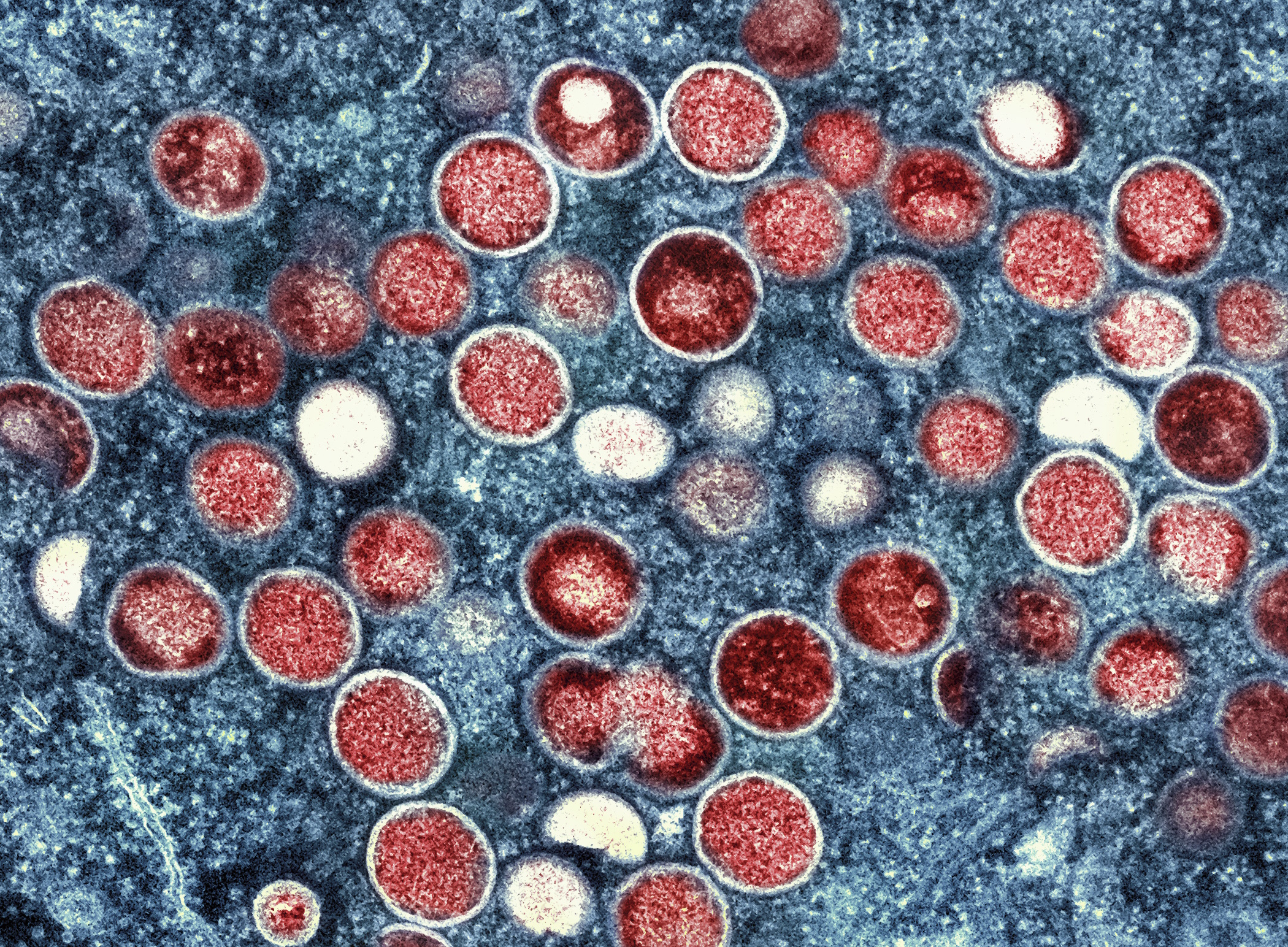 FILE - This image provided by the National Institute of Allergy and Infectious Diseases shows a colorized transmission electron micrograph of monkeypox particles (red) found within an infected cell (blue), cultured in the laboratory that was captured and color-enhanced at the NIAID Integrated Research Facility in Fort Detrick, Md. Kenya and the Central African Republic declared new outbreaks of mpox Wednesday, July 31, 2024, as Africa's health officials are racing to contain the spread of the disease in a region lacking vaccines.  (NIAID via AP, File)