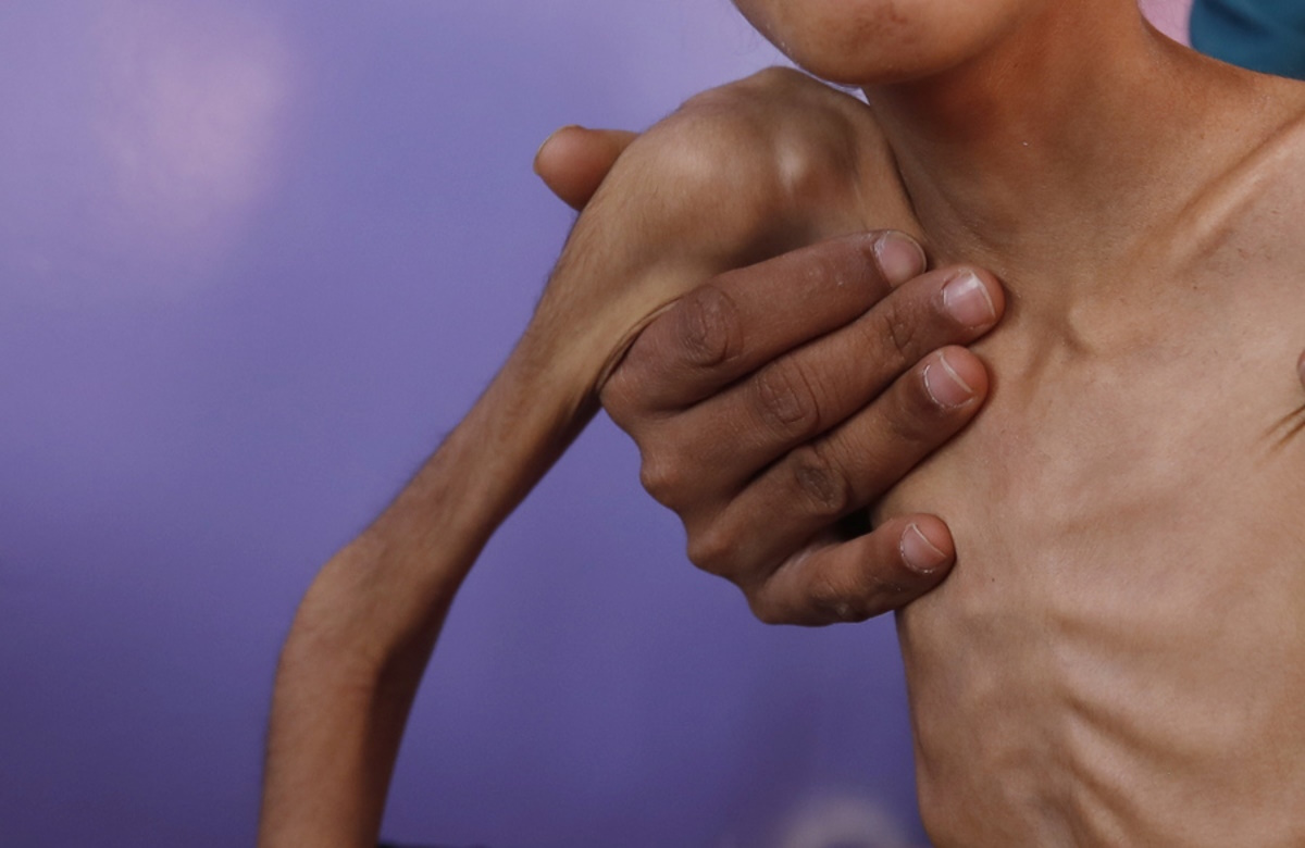 epa08166320 A medic checks malnourished child Radiah Nasser Ali, at a hospital in Sana'a, Yemen, 19 January 2020 (issued 26 January 2020). Radiah Ali, who is 11 years old, is one of hundreds of thousands of Yemeni children at risk of starvation amid the five-year conflict between the Houthi rebels and Saudi-backed government forces. Around 30,000 children die from malnutrition every year in Yemen, according to UNICEF. Yemen has been locked in a civil war between Houthi rebels and pro-government forces since 2015, leaving more than 20 million people without enough food to eat.  EPA