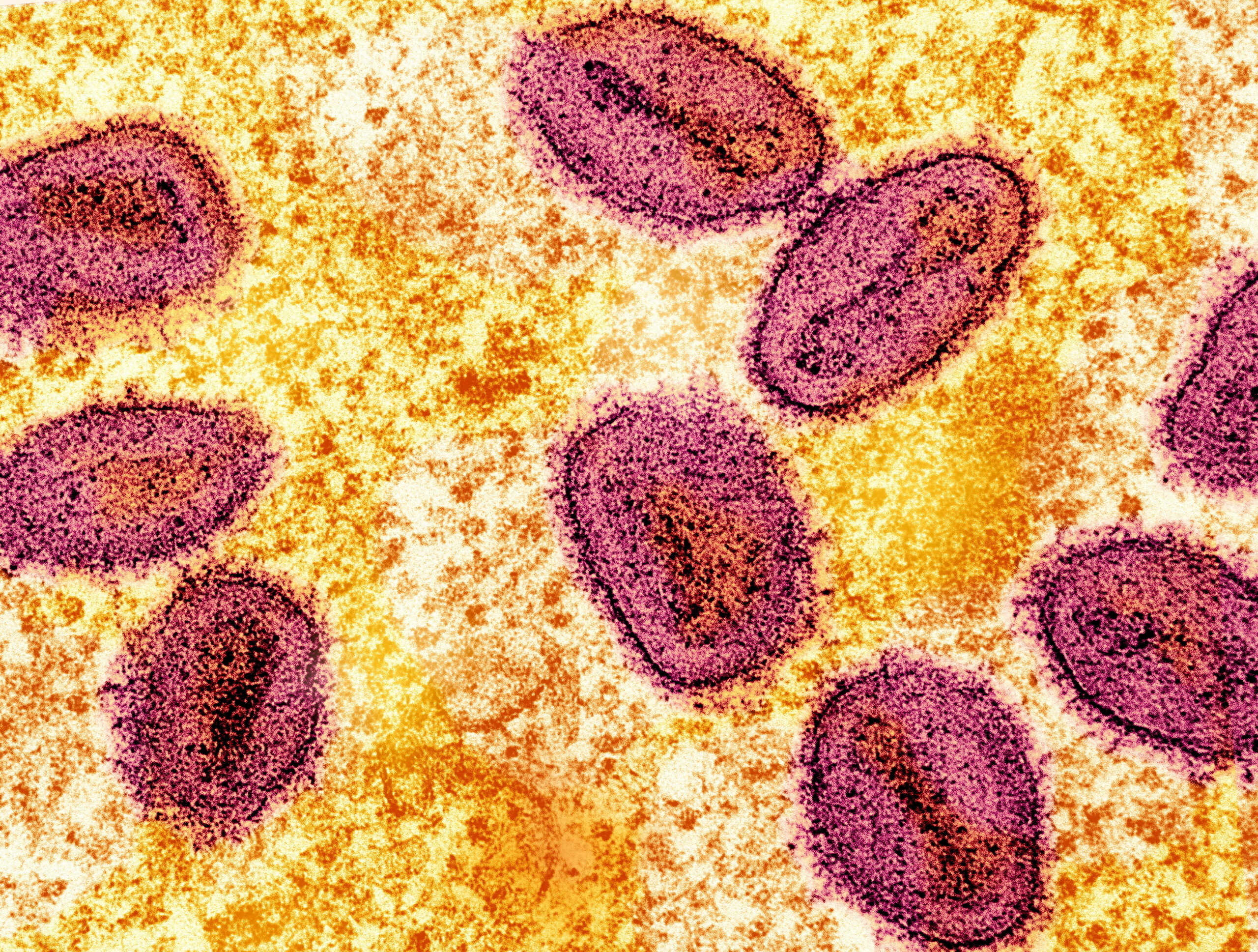 FILE PHOTO: An undated colorized transmission electron micrograph of mpox virus particles (pink) found within an infected cell (yellow), cultured in the laboratory, captured at the National Institute of Allergy and Infectious Diseases (NIAID) Integrated Research Facility (IRF) in Fort Detrick, Maryland.  NIAID