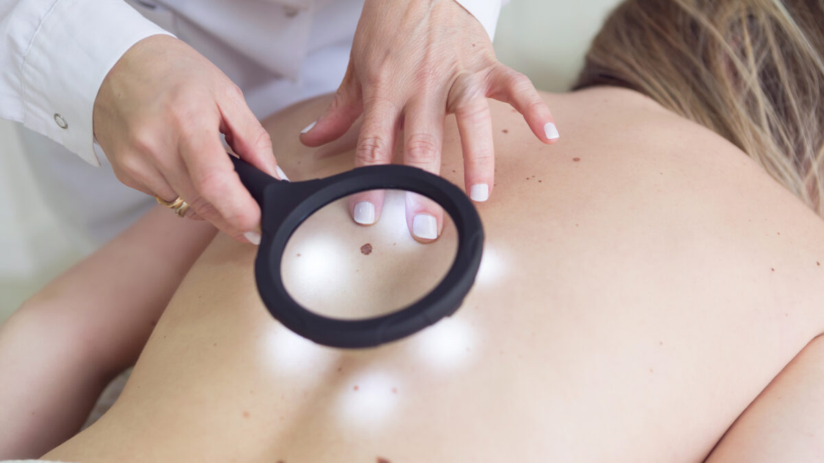 Female doctor examining moles of a patient with a magnifying glass - Buenos Aires - Argentina