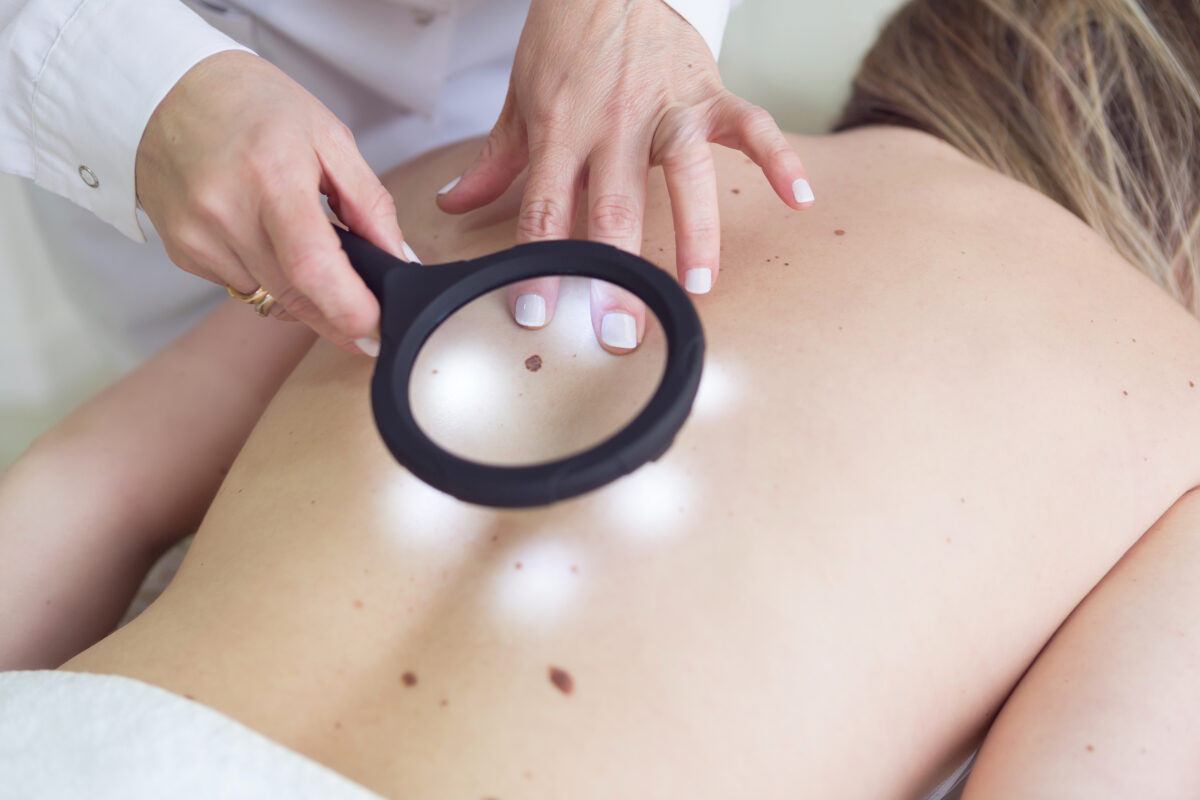 Female doctor examining moles of a patient with a magnifying glass - Buenos Aires - Argentina